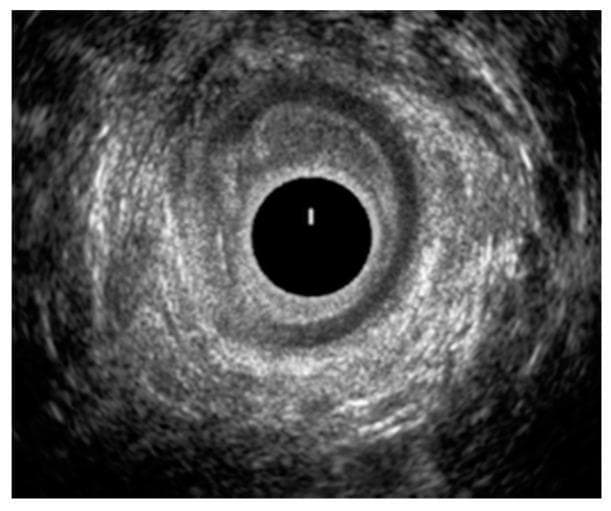 This diagnostic image is an endoanal ultrasound (EAUS) cross-section of the middle anal canal. The image shows the characteristic circular anatomy of the anal canal with concentric rings of varying echogenicity. At the center is a dark, anechoic circle representing the ultrasound probe within the lumen. Surrounding this are the distinct anatomical layers, primarily the hypoechoic (darker) internal anal sphincter (IAS) and the more hyperechoic (brighter) external anal sphincter. The primary clinical finding is a significant structural disruption and discontinuity of the internal anal sphincter, visible as a laceration between the 7 o'clock and 11 o'clock positions. This defect is characterized by a break in the normally continuous hypoechoic muscular ring, indicating tissue compromise. The image serves as a clinical illustration for diagnosing sphincter injuries, which are critical in the assessment of fecal incontinence and obstetric trauma. Target audience includes gastroenterology and colorectal surgery specialists focusing on pelvic floor integrity.