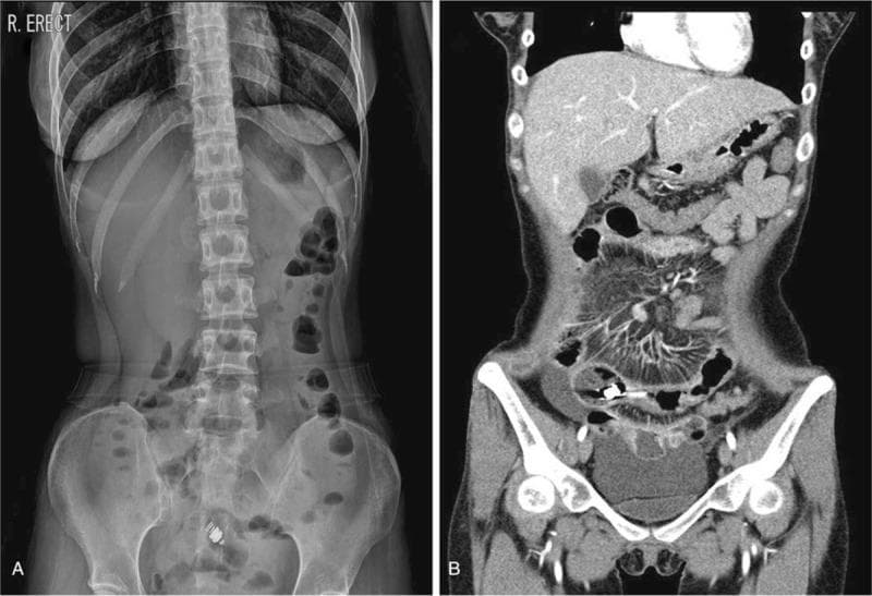 A two-panel composite showing diagnostic abdominal imaging for a small bowel obstruction. Image A is a frontal erect abdominal radiograph (X-ray) demonstrating the 'stepladder sign,' characterized by multiple dilated loops of small bowel with air-fluid levels, indicating mechanical obstruction. A radiopaque, cylindrical video capsule endoscopy (VCE) device is visible as a foreign body retained in the pelvic region. Image B is a coronal view from a Computed Tomography (CT) scan of the same patient. The CT demonstrates multifocal mural thickening and luminal narrowing (stenosis) within the ileum, consistent with Crohn's disease complications. The retained endoscopy capsule is identified as a high-attenuation object lodged proximal to a site of ileal stenosis. Proximal small bowel dilation is observed, corroborating the radiographic findings of obstruction. This comparison illustrates the complication of capsule retention in patients with inflammatory bowel disease and intestinal strictures.