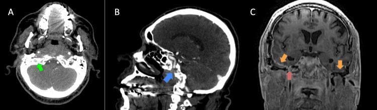 A multi-panel diagnostic imaging study featuring CT and MRI scans of the skull base and temporal bones. Panel A (Axial CT): Shows focal sclerosis of the skull base (green arrow), typical of chronic sequelae from osteomyelitis. Panel B (Sagittal CT): Demonstrates postsurgical changes in the right temporal region (blue arrow) without acute bony destruction. Panel C (Coronal T1-weighted post-contrast MRI): Displays dural thickening and abnormal enhancement (orange arrows) along the bilateral petrous pyramids and internal auditory canals (IAC). A central region of persistent skull base osteomyelitis (red arrow) is identified, extending across the midline between the right and left temporal bones. This series illustrates clinical findings of persistent or recurrent skull base osteomyelitis with associated pachymeningeal involvement, relevant for neuroradiology and infectious disease specialties.