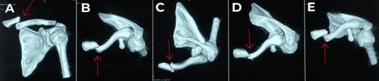 This diagnostic image displays a series of five three-dimensional (3D) computed tomography (CT) reconstructions (labeled A through E) of the left shoulder girdle, focusing on a medial end clavicle fracture. The views provide a multiplanar perspective of the skeletal anatomy, including the clavicle, scapula, and proximal humerus. Red arrows in each frame highlight the fracture site, which is categorized as an Edinburgh type 1 B1 displaced extra-articular fracture. The imaging demonstrates a complete break at the medial third of the clavicle with significant superior and posterior displacement of the medial fragment relative to the lateral segment. The sternoclavicular joint appears intact, confirming the extra-articular nature of the injury. These 3D reconstructions are critical for preoperative planning in orthopedic surgery to assess the degree of displacement, rule out intra-articular extension, and evaluate the proximity of bone fragments to underlying neurovascular structures such as the subclavian vessels.
