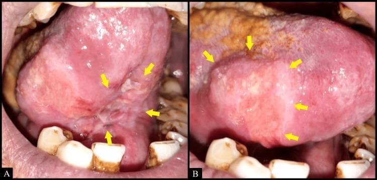 Two-panel intraoral clinical photograph (A and B) demonstrating a large, irregularly shaped ulcer located on the tongue and floor of the mouth. Panel A shows the ulcer extending from the ventral surface of the tongue to the floor of the mouth, while Panel B highlights its involvement along the right lateral border of the tongue. Yellow arrows delineate the margins of the lesion, which features edematous, raised, and slightly indurated borders. The ulcerated bed exhibits a heterogeneous appearance with mixed areas of erythematous (reddish) and leukoplakic (whitish) tissue, along with surface irregularities and sloughing. The surrounding oral mucosa appears erythematous, and there is evidence of yellowish-white coating on the dorsal tongue, suggestive of secondary candidiasis. The clinical presentation is highly relevant for the differential diagnosis of oral squamous cell carcinoma, deep fungal infections (such as histoplasmosis), or chronic traumatic ulcers. The educational focus is on identifying morphology and anatomical distribution of chronic oral ulcerative lesions in clinical dentistry and pathology.