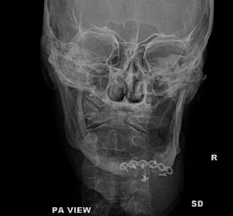 This posteroanterior (PA) radiograph of the skull and facial bones demonstrates internal fixation hardware in the mandible with evidence of mechanical failure. A metallic reconstruction mini-plate is positioned along the parasymphysis and anterior body of the mandible, secured by several cortical screws. A clear discontinuity or fracture is visible within the plate structure at the right parasymphysis region, indicative of hardware failure. There is associated bone lucency around several screw sites, which may suggest screw loosening, focal osteolysis, or localized infection. The underlying mandibular bone shows a persistent fracture line or non-union at the site of the plate break. The surrounding craniofacial structures, including the orbits, nasal cavity, and zygomatic arches, appear grossy intact and symmetric. This image illustrates post-operative complications in maxillofacial trauma management, specifically hardware fatigue and potential secondary infection in a mandibular fracture case.
