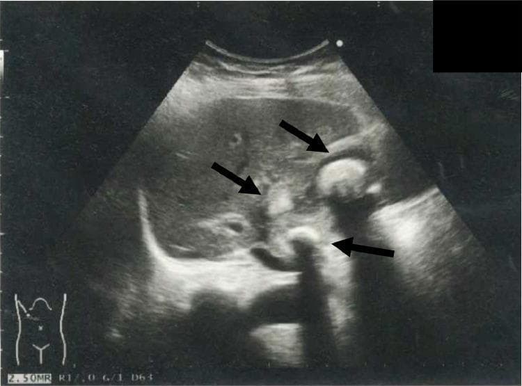 This abdominal ultrasonography image demonstrates the gallbladder in a patient with cholelithiasis. The primary findings consist of multiple hyperechoic structures (indicated by black arrows) within the gallbladder lumen, consistent with cholelithiasis (gallstones). These stones exhibit high echogenicity and are accompanied by prominent posterior acoustic shadowing, a hallmark diagnostic feature of dense calcified structures on ultrasound. The gallbladder wall appears thickened, suggesting underlying inflammation or cholecystitis. The surrounding liver parenchyma shows a relatively homogeneous echotexture, providing a clear acoustic window for the gallbladder. This diagnostic image is used to assess biliary pathology and plan clinical interventions such as percutaneous transhepatic gallbladder drainage (PTGBD). The orientation is shown via the body habitus icon in the bottom-left corner, indicating a right upper quadrant scan. This visual serves as a primary tool for medical students and clinicians to identify the classic sonographic presentation of gallstones and associated pericholecystic changes.