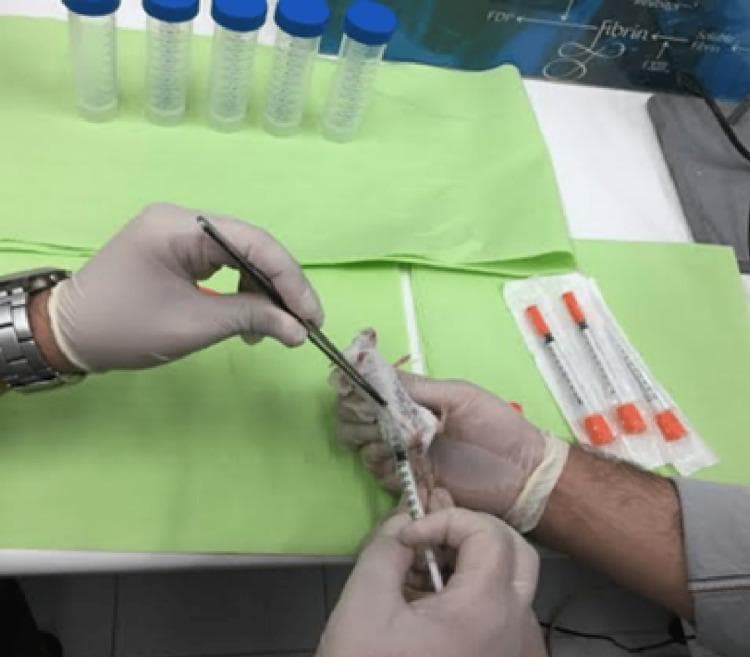 A clinical photograph depicting a laboratory setup for an in vivo cancer research procedure. The image shows an operator performing a subcutaneous injection into the mammary fat pad of a light-colored laboratory mouse. The mouse is positioned on its back on a green surgical drape, held securely by a gloved hand and specialized forceps for precision. A 1 ml insulin syringe with a fine-gauge needle is visible at the injection site. The procedural environment includes five blue-capped centrifuge tubes arranged in a row and three sterile, individually wrapped insulin syringes with orange caps to the right. This visual demonstrates the methodology for tumor cell inoculation, specifically Triple-Negative Breast Cancer (TNBC) cell lines like MDA-MB 231, to establish animal models for oncological study. The use of aseptic technique, including gloves and drapes, is evident, highlighting the standard protocol for laboratory animal interventions in biomedical research.