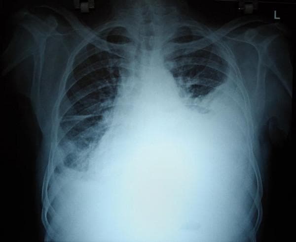 A posterior-anterior (PA) view chest X-ray demonstrating a massive left-sided pleural effusion. The left hemithorax shows extensive, near-complete homogeneous opacification, resulting in the obscuration of the left hemidiaphragm, the cardiac border (silhouette sign), and the costophrenic angle. A clear meniscus sign is visible at the superior margin of the opacity, characteristic of fluid collection in the pleural space. There is significant mass effect evidenced by a contralateral (rightward) shift of the mediastinum and trachea. The right lung appears relatively clear with preserved lung markings and open costophrenic angles, though the lower zone is partially obscured by the mediastinal displacement. This radiographic presentation is typical of a large-volume pleural effusion, which clinically was found to be a hemothorax. The image is an essential educational tool for identifying signs of tension-related fluid accumulation and differentiating massive effusion from total lung collapse.