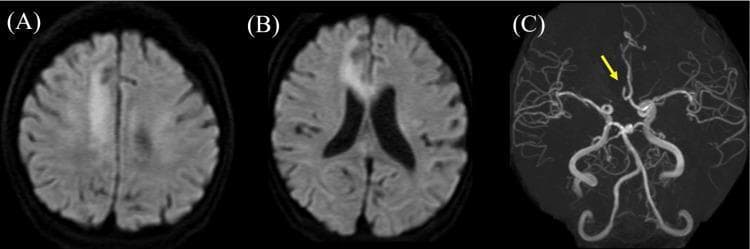 This composite diagnostic image illustrates an acute ischemic stroke within the right anterior cerebral artery (ACA) territory using MRI and MRA modalities. Panels (A) and (B) are axial Diffusion-Weighted Imaging (DWI) scans of the brain. (A) shows a distinct area of high signal intensity (hyperintensity) in the right frontal lobe convexity, indicating restricted water diffusion characteristic of acute infarction. (B) displays similar hyperintensity at a lower axial level, involving the corpus callosum and medial frontal cortex. Panel (C) presents a Magnetic Resonance Angiogram (MRA) of the intracranial vasculature. A yellow arrow points to the right ACA, which appears truncated and lacks normal distal signal, confirming an occlusion. The combined imaging demonstrates a large territory infarction secondary to proximal arterial blockage. This resource is suitable for medical education regarding radiological signs of ischemic stroke, neuroanatomy of the ACA, and the clinical application of DWI and MRA in cerebrovascular emergencies.