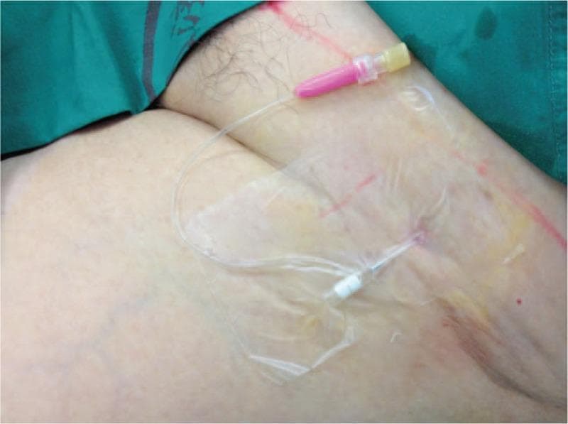 Clinical photograph of a continuous fascia iliaca compartment block (FICB) setup in the inguinal region. The image displays a long-axis view of an indwelling cannula inserted into the skin, secured with a large, transparent, sterile adhesive film dressing. Attached to the cannula is a clear flexible extension tube terminating in a pink luer-lock connector with a yellow cap, intended for connection to a patient-controlled analgesia (PCA) pump. The surrounding skin exhibits anatomical landmarks including the inguinal crease and linear surgical skin markings in red. Yellowish skin discoloration at the site suggests the application of topical antiseptic solution, such as povidone-iodine. This visual demonstrates the postoperative analgesia protocol for lower extremity surgeries, specifically focusing on the stabilization and placement of a regional anesthesia catheter for continuous local anesthetic infusion.