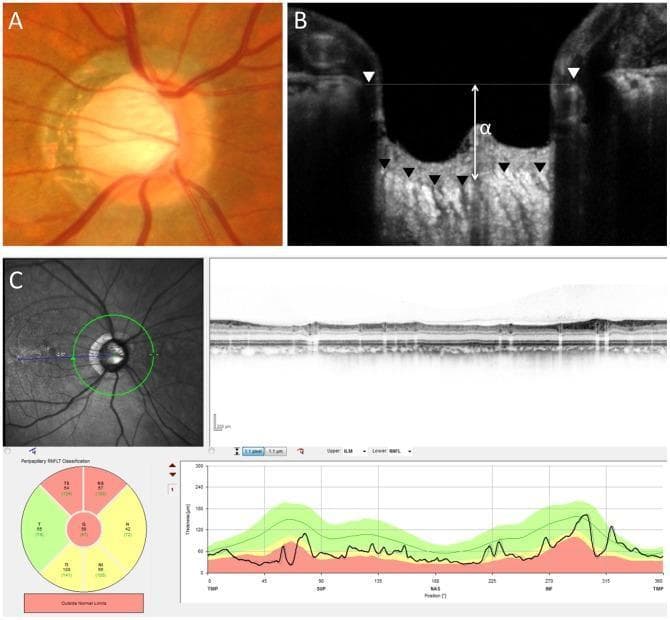 This composite image illustrates diagnostic findings of primary open-angle glaucoma through multimodal ophthalmic imaging. Panel A is a fundus photograph displaying a glaucomatous optic disc characterized by a large vertical cup-to-disc ratio, significant central excavation (cupping), and thinning of the neuroretinal rim, particularly in the superior and inferior poles. Panel B presents a vertical Optical Coherence Tomography (OCT) B-scan of the optic nerve head, measuring the distance (α = 406 µm) between the Bruch's membrane opening (BMO) reference line and the anterior surface of the lamina cribrosa. Panel C shows a circular OCT scan and accompanying quantitative analysis of the circumpapillary retinal nerve fiber layer (cpRNFL). The analysis indicates a significantly reduced mean cpRNFL thickness of 58 µm. The included TSNIT (Temporal, Superior, Nasal, Inferior, Temporal) thickness graph and color-coded sectoral map demonstrate thinning outside normal limits (red sectors), particularly in the superior and nasal regions. This clinical case highlights the correlation between structural optic disc changes and the quantitative loss of the retinal nerve fiber layer in glaucomatous neuropathy.