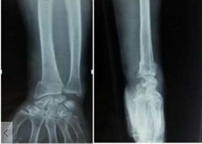 This diagnostic image consists of two X-ray views (anteroposterior and lateral) of a human wrist, demonstrating a displaced distal radius fracture. In the anteroposterior (AP) view, there is a clear transverse fracture line at the distal metaphysis of the radius with lateral displacement of the distal fragment and associated comminution. The ulnar styloid also appears involved, suggesting a potential associated injury. The lateral view reveals significant dorsal displacement and dorsal angulation of the distal radial fragment (characteristic of a Colles-type fracture pattern), along with impaction resulting in radial shortening. The radiocarpal joint alignment is disrupted due to the fracture angulation. This imaging is clinically significant for orthopedic evaluation, planning of surgical reduction, and assessing the degree of articular involvement in common distal forearm injuries.