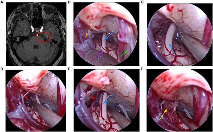 This composite image illustrates the clinical progression and surgical treatment of trigeminal neuralgia using microvascular decompression (MVD). Panel A is a preoperative axial MRI scan of the brain, with a red circle highlighting neurovascular compression at the root entry zone of the right trigeminal nerve in the cerebellopontine angle. Panels B through F provide a sequence of intraoperative endoscopic photographs showing the surgical workflow. Key anatomical structures identified include the trigeminal nerve (blue arrow), brainstem (purple arrow), petrosal vein (orange arrow), and facial nerve (green arrow). The sequence demonstrates the exploration and dissection of arachnoid adhesions (Panels B-D), identifying a petrosal vein branch (red arrow) as the offending vessel compressing the nerve (Panel E). The final panel (F) depicts the therapeutic intervention, where a Teflon pad (yellow arrow) is surgically interposed between the trigeminal nerve and the offending vessel to achieve mechanical decompression. This sequence serves as an educational tool for neurosurgical training, demonstrating the suboccipital retrosigmoid approach and the efficacy of endoscopic visualization in identifying subtle vascular compression.