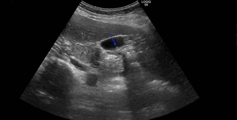 This diagnostic image is an abdominal ultrasound in a transverse or oblique plane focusing on the gallbladder. The gallbladder appears as a well-defined, anechoic (black) fluid-filled structure. A blue arrow identifies a small, hyperechoic, non-shadowing intraluminal lesion measuring approximately 7 mm, consistent with a gallbladder polyp. The polyp is attached to the dependent wall of the gallbladder and does not demonstrate posterior acoustic shadowing, which helps differentiate it from cholelithiasis (gallstones). The surrounding hepatic parenchyma exhibits a homogeneous, medium-level echogenicity. The gallbladder wall appears slightly thickened, suggesting possible chronic cholecystitis. This image is used to demonstrate the sonographic appearance of gallbladder polyps, which in this clinical context was pathologically confirmed as heterotopic pancreatic tissue. The educational focus is on the detection and characterization of intraluminal gallbladder pathologies using ultrasonography.