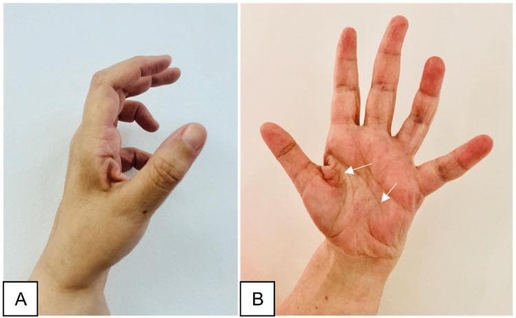 Two-panel clinical photograph demonstrating the late sequelae of a peripheral nerve injury in the hand, specifically illustrating features of ulnar nerve palsy. Image A (lateral view) shows a classic 'claw hand' deformity, characterized by hyperextension at the metacarpophalangeal (MCP) joints and flexion at the interphalangeal (IP) joints, most prominent in the ring and little fingers. The thumb appears adducted and flexed. Image B (anterior/palmar view) displays generalized muscle atrophy of the hand, with significant hollowing of the hypothenar eminence and interosseous spaces (indicated by white arrows). Notably, the thenar eminence remains relatively spared, suggesting the median nerve's innervation to the thenar muscles is intact. This combination of clawing and selective intrinsic muscle wasting is an important educational marker for localizing nerve lesions to the distal ulnar nerve (e.g., Guyon's canal or post-surgical complication). The images illustrate the clinical presentation of chronic motor deficit and the characteristic postural changes resulting from unbalanced muscle pull in the hand.