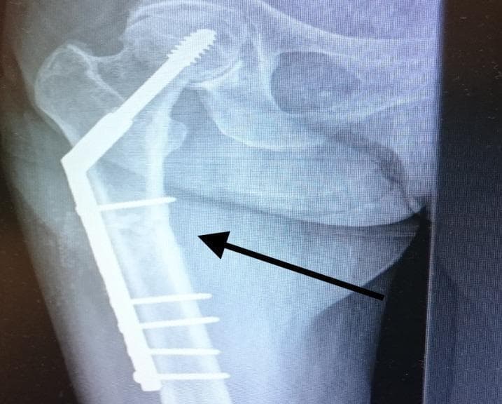 Anteroposterior (AP) X-ray of the right hip and proximal femur demonstrating internal fixation of a femoral fracture. The primary hardware is a dynamic hip screw (DHS) system, featuring a large-diameter lag screw positioned through the femoral neck into the center of the femoral head. This lag screw is coupled with a side plate extending down the lateral aspect of the femoral shaft. The side plate is secured to the femoral diaphysis with multiple cortical screws. A black arrow points toward the subtrochanteric region of the femur, highlighting the area of a previously diagnosed atypical fracture. The surrounding bone shows evidence of osteoporosis, characterized by thinned cortices and altered trabecular patterns. The image illustrates postoperative management of hip fractures and the structural components required for stabilization of the proximal femur in geriatric patients.