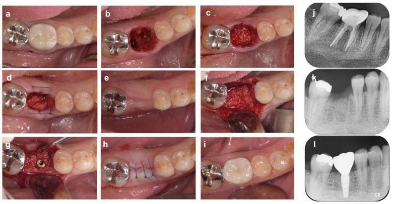 This composite figure illustrates a clinical timeline of Alveolar Ridge Preservation (ARP) and subsequent implant placement in the mandibular right first molar (#46). Panels (a)-(i) present intraoral clinical photographs, while (j)-(l) show corresponding periapical radiographs. The sequence begins with a tooth extraction due to root fracture (b), followed by grafting the socket with bovine xenogeneic bone (c). An absorbable collagen membrane is applied and stabilized with cross-mattress sutures (d). A 4-month healing phase shows slight ridge width reduction (e) before surgical re-entry and implant placement (f-g). Post-implantation suturing (h) leads to the final installation of a superstructure (i) at 9 months. Radiographically, the preoperative state (j) exhibits vertical bone resorption. Immediate post-ARP imaging (k) shows the radiopaque xenograft material within the socket. The 9-month follow-up radiograph (l) demonstrates successful osseointegration of the dental implant with increased bone density and stabilized alveolar height, confirming the effectiveness of the ARP technique in maintaining bone volume for prosthetic rehabilitation.