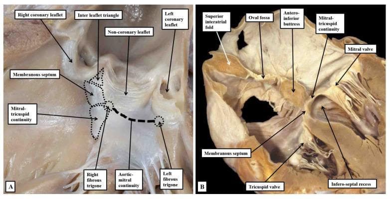 This figure consists of two clinical photographs of human heart specimens, providing a detailed anatomical study of the cardiac skeleton and outflow tracts. Panel A illustrates an infant heart with the left ventricular outflow tract (LVOT) opened. It demonstrates the structural components of the central fibrous body, including the membranous septum, right fibrous trigone, and left fibrous trigone. Key landmarks highlighted include the aortic-mitral fibrous continuity and its relationship to the interleaflet triangle between the right and non-coronary aortic sinuses. Panel B presents a 'four-chamber' section of an adult heart, emphasizing the structural support of the atrial septum. Visible features include the oval fossa, the antero-inferior buttress, and the infero-septal recess. The image depicts how the mitral-tricuspid continuity forms the roof of the infero-septal recess, providing a basal anchor for the interatrial septum. These images serve as educational materials for understanding cardiac surgical anatomy, specifically the relationships between the atrioventricular valves and the aortic root.