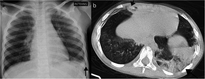 This composite diagnostic image features a pediatric chest X-ray (a) and an axial computed tomography (CT) scan (b) in a lung window, illustrating indeterminate pulmonary findings. The chest X-ray demonstrates a focal, unilateral opacity in the lower zone of the left lung, with relatively clear lung parenchyma elsewhere. The axial CT scan provides a more detailed view, revealing bilateral peripheral consolidations. The most prominent consolidation is located in the left lower lobe, with additional involvement noted in the middle lobe and the internal segment of the right lower lobe (indicated by arrows). These consolidations are subpleural in distribution and lack significant central or perihilar involvement. The case illustrates a ‘predominant consolidation’ pattern which, while maintaining a peripheral and lower lobe distribution, is considered indeterminate or atypical for standard COVID-19 presentations in pediatric patients. The images serve as an educational example of how CT can clarify findings that appear unilateral on plain radiography and help distinguish between typical, indeterminate, and atypical viral pneumonia patterns.
