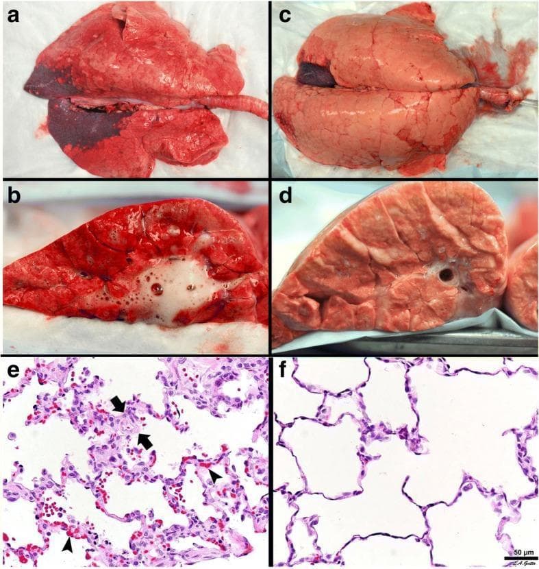 This composite educational graphic presents a comparison of lung pathology and histology in a porcine model of acute respiratory distress syndrome (ARDS), contrasting two ventilation protocols: ARDSnet (low tidal volume) and time-controlled adaptive ventilation (TCAV).
Top Panels (a-d): Gross pathology at necropsy with lungs inflated to 25 cmH2O. Panel (a) shows the ARDSnet lung with significant dark red consolidation, inflammation, and incomplete inflation. Panel (b) reveals a cut surface with diffuse inflammation and copious white edema foam in the airways. In contrast, panel (c) displays a TCAV-treated lung that appears healthy, pink, and fully inflated, with the cut surface in panel (d) showing dry, aerated tissue without edema.
Bottom Panels (e-f): H&E stained histology (50 μm scale). Panel (e) demonstrates classic ARDS features: marked alveolar wall thickening (arrows), significant vessel congestion (arrowheads), and inflammatory infiltration. Panel (f) shows the TCAV group with preserved architecture, thin alveolar septa, and clear airspaces, illustrating the educational concept of ventilator-induced lung injury (VILI) prevention through lung stabilization.