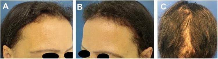 This composite clinical photograph illustrates the 'acute telogen effluvium triad' following resolution, specifically in a patient post-weight loss. Image A (frontal view) demonstrates a 'frontal fringe' composed of short, regrowing hairs along the anterior hairline. Image B (lateral view) shows bitemporal rarefaction, characterized by a visible decrease in hair density and thinning of hair shafts in the temporal region, making the scalp more prominent. Image C (posterior view) displays an 'occipital fringe,' where hair regrowth is evident through varying hair lengths and thicknesses in the occipital region. Collectively, these images highlight the characteristic clinical signs of hair recovery after a telogen effluvium event. The material is intended for intermediate to advanced medical learners in dermatology, demonstrating the differential diagnosis between active hair loss and clinical signs of recovery/regrowth.
