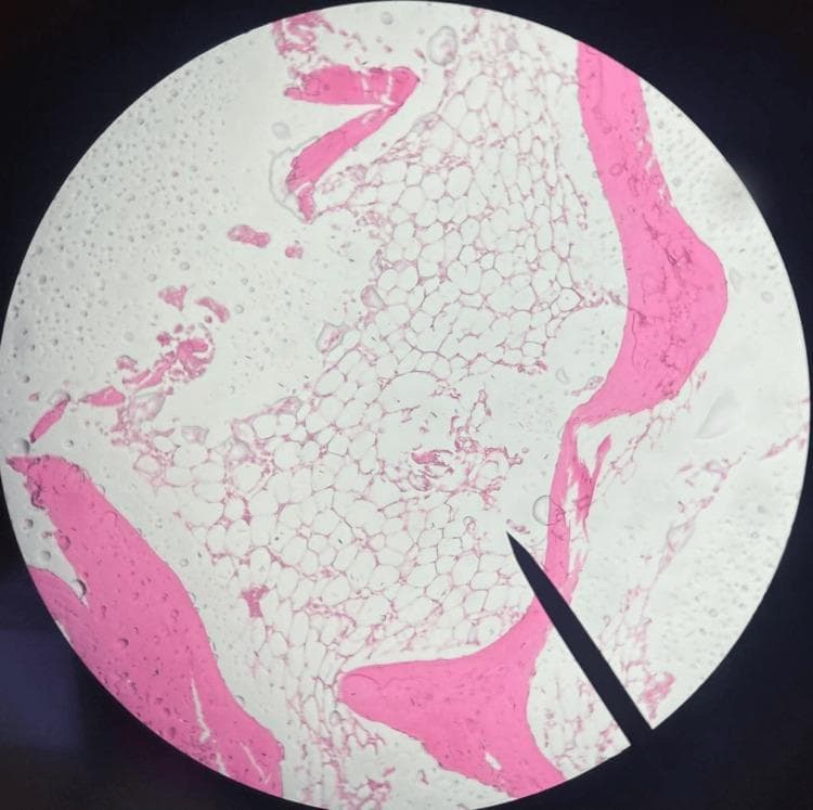 This diagnostic image is a low-magnification light microscopy photomicrograph of a bone marrow trephine biopsy, likely stained with hematoxylin and eosin (H&E). The specimen exhibits marked hypocellularity, a hallmark of severe aplastic anemia. The hematopoietic space is predominantly occupied by clear, vacuolated adipocytes (fatty marrow), with a notable absence of normal myeloid, erythroid, and megakaryocytic cell lines. Eosinophilic (pink) trabecular bone spicules are visible at the periphery and interspersed within the marrow cavity, providing structural context. The clinical significance of this finding is the demonstration of bone marrow failure, where the functional marrow has been replaced by adipose tissue. The absence of infiltrative abnormal cells or significant fibrosis is a key negative finding for differentiating this from myelodysplastic syndromes or myelofibrosis.