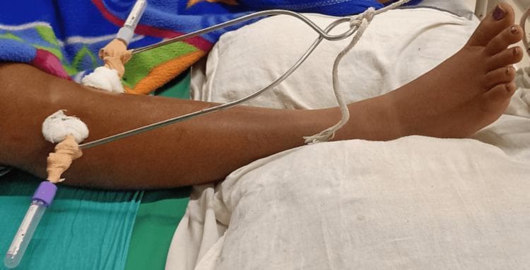 A clinical photograph of a human lower extremity illustrating a proximal skeletal traction setup. The image shows a metal Steinman pin or Kirschner wire inserted transversely through the proximal tibia or distal femur region of the leg. The pin is secured on both ends with protective caps and padded with gauze and adhesive tape at the entry and exit sites to maintain sterility and prevent skin irritation. A metal traction stirrup is attached to the pin, extending distally over the lower leg. A white traction rope is tied to the central eyelet of the stirrup, facilitating the application of longitudinal force for fracture reduction or deformity correction. The leg is positioned supine on hospital linens, and the foot is visible in a neutral to slightly plantarflexed position. This procedural image demonstrates the mechanical components and anatomical placement necessary for stabilizing lower limb injuries or managing pre-operative orthopedic conditions like hip flexion deformities.