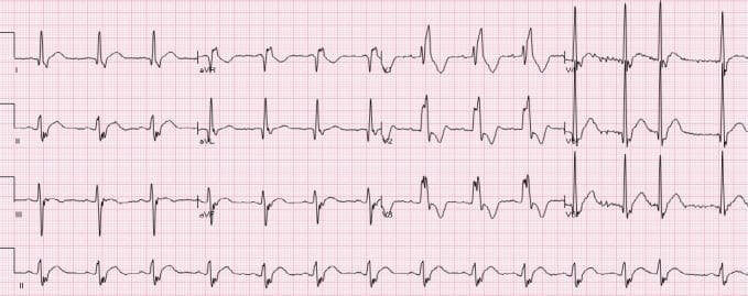 This diagnostic image is a 12-lead electrocardiogram (ECG) demonstrating a combination of conduction abnormalities and ST-segment deviations. The ECG shows a widened QRS complex with an rSR' pattern in the right precordial leads (V1-V3), characteristic of a Right Bundle Branch Block (RBBB). Concomitant left axis deviation is present, indicative of a Left Anterior Fascicular Block (LAFB), together forming a bifascicular block pattern. Notably, there is mild, diffuse ST-segment elevation (STE) visible in the lateral leads (I, aVL, V4-V6) and inferior leads (II, aVF). In the clinical context of non-ischemic dilated cardiomyopathy with negative cardiac biomarkers, these ST-segment changes represent a chronic, non-ischemic ST-elevation (NISTE) pattern rather than acute myocardial infarction. The ST segments appear relatively stable and are associated with secondary repolarization changes from the intraventricular conduction delay. This tracing serves as an educational example of how baseline conduction defects and cardiomyopathy can simulate or mask ischemic patterns, emphasizing the importance of clinical correlation and comparison with prior ECGs in diagnosis.