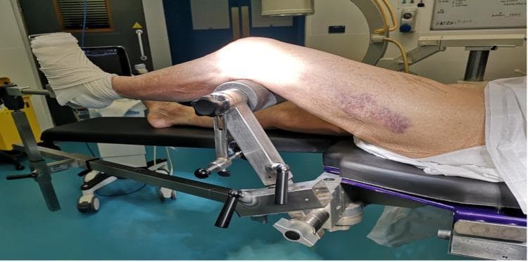 A clinical photograph demonstrates the surgical positioning for an indirect reduction of a distal femur fracture on a traction table. The patient is in a supine position with the left leg elevated. A specialized tibia nailing attachment is utilized, featuring a metal framework with adjustable femoral condyle pads that provide posterior support at the level of the distal femur and proximal tibia, maintaining knee flexion. Significant ecchymosis is visible on the anterolateral aspect of the left thigh, indicative of soft tissue trauma associated with the fracture. The left foot and ankle are heavily wrapped in white protective wool and secured with an adhesive bandage to a metal traction unit footplate. This setup allows for longitudinal traction and skeletal alignment under image intensifier guidance. The contralateral (right) leg remains in a neutral supine position on the radiolucent table. This configuration is typical for orthopedic procedures requiring stable limb fixation and intraoperative fluoroscopy for intra-articular fracture management.