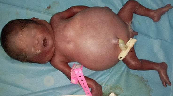 A clinical photograph of a neonate demonstrating Hydrops Fetalis (anasarque fœto-placentaire). The primary visual finding is severe, generalized edema, most notably presenting as marked abdominal distension (ascites). The newborn's skin appears erythematous and translucent, characteristic of significant subcutaneous fluid accumulation. The extremities appear swollen, and the facial features show mild puffiness. A standard white plastic umbilical clamp is visible on the umbilical cord stump. The infant is placed on a blue surgical drape, and a pink identification band is attached to the right wrist. This image serves as an educational illustration of fetal hydrops, a life-threatening condition defined by abnormal fluid accumulation in two or more fetal compartments, often associated with severe anemia, heart failure, or polyserositis. This specimen is relevant to neonatal intensive care, obstetrics, and pediatric pathology.