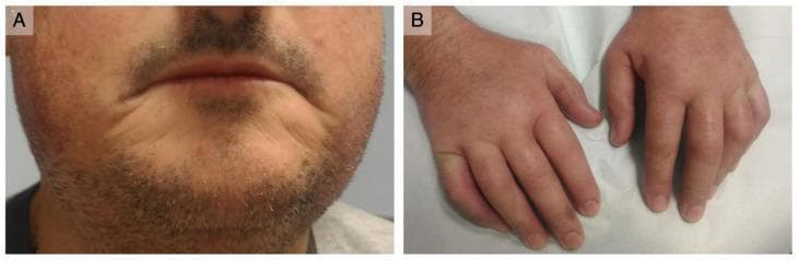 Two-panel clinical photograph demonstrating characteristic features of systemic sclerosis (SSc). Figure A shows 'scleroderma facies' in the perioral region, characterized by thin, retracted lips and skin tightening with a paucity of normal wrinkles. Visible telangiectasias are present on the malar area, and the nose appears sharpened due to skin tethering. Figure B depicts both hands with prominent 'puffy fingers,' a sign of the early edematous phase of SSc. The digits exhibit diffuse swelling and a smooth, taut skin texture. There is a lack of digital ulcers or pitting scars on the fingertips. Subtle bluish discoloration on the right hand's knuckle suggests active Raynaud’s phenomenon. These visual findings are diagnostic hallmarks of systemic sclerosis, indicating progressive dermal fibrosis and vascular dysfunction.