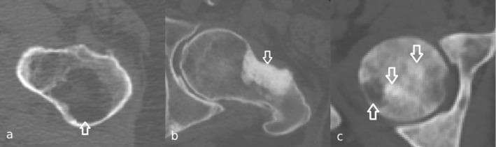 This diagnostic image displays three axial computed tomography (CT) scans of the femur, illustrating the primary patterns of bone metastasis. Panel (a) shows an osteolytic lesion, characterized by a focal area of bone destruction with significantly decreased radiodensity (darkness) and thinning of the cortical bone, indicating high osteoclastic activity. Panel (b) demonstrates an osteoblastic (sclerotic) metastasis, visible as a localized region of markedly increased bone density (brightness/opacity) due to excessive bone formation. Panel (c) reveals a mixed metastasis, featuring a heterogeneous presentation with coexisting areas of radiolucent bone destruction and radiopaque bone formation. Arrows highlight the specific metastatic sites in each panel. This comparison is clinically significant for oncological staging and assessing fracture risk in patients with primary malignancies such as breast, prostate, or lung cancer. The images serve as an educational tool for differentiating bone remodeling responses in metastatic disease.