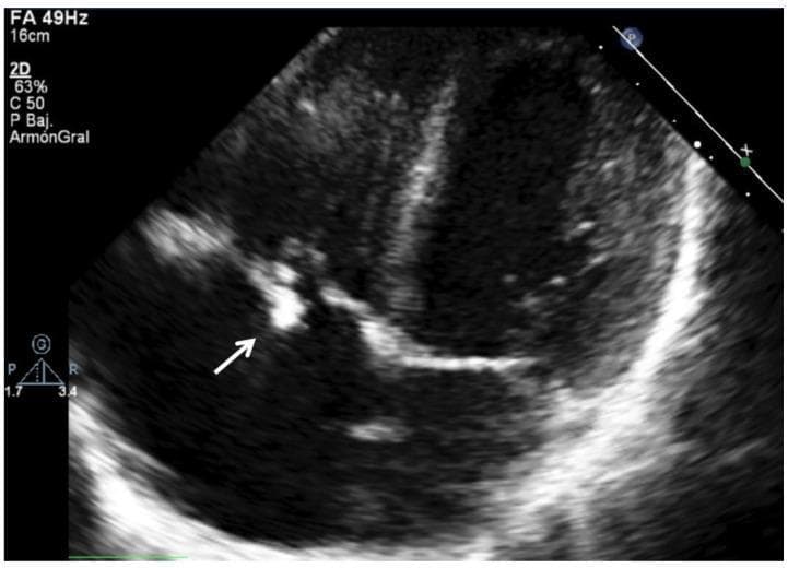 This diagnostic image is a 2D transthoracic echocardiogram (TTE) in a pediatric patient, focusing on the right heart chambers. The image demonstrates a prominent, hyperechoic (bright) irregular mass attached to the tricuspid valve leaflet, as indicated by the white arrow. This echogenic structure is characteristic of a vegetation, a hallmark of infective endocarditis. The valve leaflets themselves appear thickened and irregular, which disrupts normal coaptation. The clinical context involves a 16-year-old male with a history of congenital heart disease (restrictive perimembranous VSD) and tricuspid regurgitation, now presenting with Viridans Streptococcus endocarditis. The image illustrates the typical ultrasonographic presentation of right-sided infective endocarditis, showing how the vegetation appears as a distinct, reflective cluster against the darker, less echogenic blood-filled chambers and myocardium. This finding is a major Duke criterion for the diagnosis of infective endocarditis.