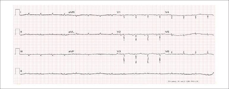 A 12-lead electrocardiogram (ECG) trace presented on standard grid paper, demonstrating several pathological findings. The rhythm is sinus with a heart rate of approximately 97 bpm. Key features include low QRS voltage in the frontal plane leads (I, II, III, aVR, aVL, aVF) and a notable poor R-wave progression across the precordial leads, specifically from V1 to V4, where the R-wave fails to gain amplitude; this finding is highly suggestive of an electrically inactive area in the anterior myocardial wall. P-wave morphology in leads II and V1 indicates left atrial overload, characterized by increased duration and potential notching. Additionally, the ECG shows indirect signs of right atrial overload (Peñaloza-Tranchesi sign) and diffuse non-specific ST-segment and T-wave abnormalities indicating ventricular repolarization changes. These findings collectively suggest chronic cardiac remodeling, potentially secondary to dilated cardiomyopathy or an old anterior wall myocardial infarction.