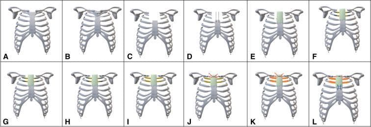 This surgical schematic algorithm illustrates a twelve-step procedure (Panels AโL) for complex chest wall reconstruction following tumor resection. The diagrams depict the thoracic cage, including the sternum, ribs, and clavicles. The sequence begins with the identification of a tumor involving the manubrium and sternoclavicular joints (B), followed by wide surgical resection of the superior sternum, medial clavicles, and adjacent ribs (C). The reconstruction phase (DโL) demonstrates the creation of a neosternum and chest wall stabilization using a combination of prosthetic materials. Key steps include the placement of a vascular graft (Hemashield) over the sternal stump (E), the use of titanium rib plates (FโG) and clavicular plates (H) for structural support, and the application of bone cement (orange) within latex molds to recreate rib and sternal volume (IโK). A sternal cable system is utilized to bridge the clavicular stumps (JโL), mimicking the function of the sternoclavicular joint. The final panel (L) shows the completed modular reconstruction, restoring anatomical integrity and thoracic stability through integrated cement, plates, and cables.