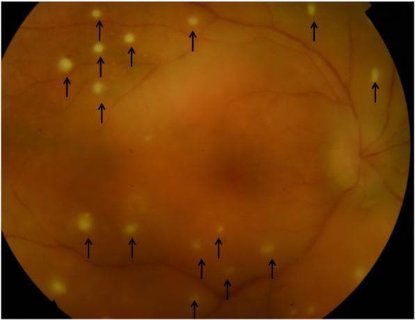This fundus color photograph illustrates clinical manifestations of posterior syphilitic uveitis. The image shows widespread, small, circular, whitish-yellowish pre-retinal lesions (indicated by black arrows) scattered across the retina. These punctate lesions, sometimes referred to as pre-retinal precipitates, are seen overlying areas of active retinitis and often represent aggregates of inflammatory cells. A generalized haziness is visible across the fundus, characteristic of vitritis (inflammation of the vitreous humor), which obscures the clarity of the underlying retinal vessels and landmarks. The optic disc is visible in the nasal periphery with relatively preserved margins. This presentation is a classic hallmark of ocular syphilis, often termed 'the great mimicker,' where inflammatory cells migrate across the retina into the vitreous. This visual material serves as an educational resource for identifying inflammatory ocular phenotypes and distinguishing pre-retinal precipitates from intra-retinal foci in the context of infectious uveitis.