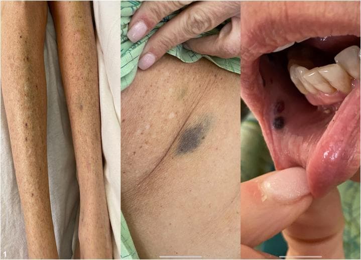 This composite clinical photograph illustrates multisite cutaneous and mucosal manifestations of drug-induced immune thrombocytopenic purpura (ITP). The left panel shows the lower extremities with a diffuse, symmetric distribution of pinpoint, non-blanching red-to-purple petechiae and larger, confluent purpuric macules. The center panel displays a close-up of the axillary region, highlighting a prominent, deep-purple ecchymosis alongside scattered petechiae, indicative of significant dermal hemorrhage. The right panel demonstrates mucosal involvement with 'wet purpura'—specifically, dark, hemorrhagic bullae and macules located on the buccal mucosa and inner lip. These findings collectively characterize a systemic bleeding diathesis, clinically relevant for identifying severe thrombocytopenia (platelet counts typically <10,000/uL) and assessing the risk of internal hemorrhage in a dermatology or hematology context.