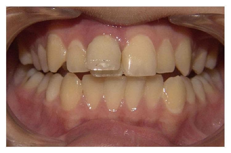 This clinical intraoral photograph demonstrates an anterior view of the maxillary and mandibular dentition with a primary focus on dental trauma. A significant crown fracture is visible on the maxillary right central incisor (tooth #8 or 11). The fracture line appears complex, with a vertical component and a transverse mesiodistal separation across the middle third of the crown. The incisal fragment is partially detached or displaced, showing a clear discrepancy in the incisal edge alignment compared to the intact maxillary left central incisor. The fracture extends cervically toward the gingival margin, and the clinical context indicates pulp exposure, making this a complicated crown fracture. The surrounding gingival tissue appears healthy with no immediate signs of acute swelling or laceration. The adjacent lateral incisors and mandibular anterior teeth remain intact, though they are visible for comparative assessment of tooth morphology and alignment. This image serves as an educational example of traumatic dental injury, specifically crown fractures in permanent dentition that necessitate endodontic evaluation and restorative management.
