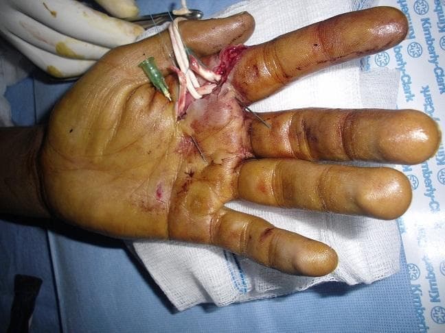 Clinical photograph of an intraoperative surgical procedure for flexor tendon repair in the hand. The image focuses on the palmar aspect, demonstrating the repair of a sectioned flexor tendon, specifically utilizing the modified Kessler suture technique. Visible components include exposed flexor tendons in Zone II, held and manipulated with surgical needles and sutures. A green-hubbed hypodermic needle is used for stabilization of the tendon ends. The surgical field shows a vertical incision near the base of the index finger and distal palmar crease, with sutures already placed in the surrounding skin. There is evidence of localized soft tissue trauma, bruising, and bloodstains. The background includes sterile surgical drapes, gauze, and a gloved hand, providing clinical context for orthopedic or plastic surgery training regarding hand trauma and tendon reconstruction.