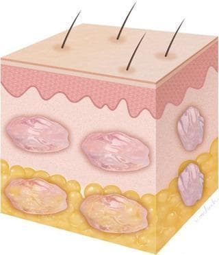 This anatomical diagram provides a 3D schematic representation of a skin biopsy-style section, illustrating a multi-layer injection technique for cosmetic or regenerative medicine. The diagram depicts three distinct integumentary layers: the epidermis, shown as a thin, undulating top layer with emerging terminal hairs; the dermis, a thicker mid-layer; and the subcutaneous layer (hypodermis) at the base, characterized by yellow globular adipose tissue. The focus of the illustration is the targeted administration of a therapeutic substance, such as polynucleotide (PN), which appears as pink boluses. The diagram demonstrates a dual-depth injection strategy: intradermal boluses located within the deep dermis and subdermal boluses positioned at the junction between the dermis and the superficial subcutaneous layer. This visual is designed to explain the clinical procedure for addressing skin depressions or volumetric loss through layered filler or biostimulator delivery. It serves as an educational tool for dermatology and aesthetic surgery to visualize precise anatomical placement of injectable substances.