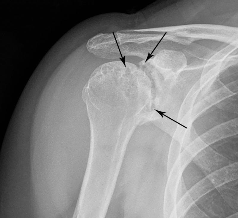 Anteroposterior (AP) conventional radiograph of the right shoulder demonstrating advanced osseous changes associated with rheumatoid arthritis. The imaging reveals marked, symmetric narrowing of the glenohumeral joint space. Significant periarticular pathology is evident, specifically numerous marginal and subchondral bone erosions (indicated by black arrows) involving both the superior and inferior aspects of the humeral head and the adjacent glenoid fossa. These erosions present as radiolucent irregularities and cortical interruptions, leading to an irregular articular contour. Additionally, soft tissue swelling is visible in the deltoid and subdeltoid regions, consistent with chronic inflammatory synovitis or bursitis. Key educational features include the demonstration of classic inflammatory arthropathy hallmarks: joint space loss, periarticular osteopenia, and marginal erosions, which distinguish this condition from degenerative osteoarthritis where subchondral sclerosis and osteophyte formation would be more prominent.