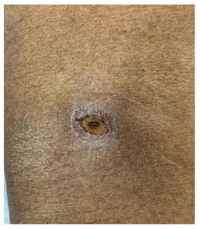 A clinical photograph showing a characteristic eschar associated with scrub typhus located on the right antecubital fossa. The lesion is approximately 7 x 5 mm, featuring a prominent, oval-shaped, necrotic central area that is dark brown to black in color and slightly depressed. This central necrotic core is surrounded by a well-demarcated, yellowish-tan intermediate ring and a peripheral zone of erythema and mild inflammation. The surrounding skin exhibits a normal texture with visible hair follicles and no evidence of diffuse rash in the immediate field of view. This visual finding is a hallmark diagnostic sign of Orientia tsutsugamushi infection, typically occurring at the site of a larval mite (chigger) bite. The image serves as a critical educational tool for identifying rickettsial-like infections in patients presenting with undifferentiated fever, particularly in endemic regions.