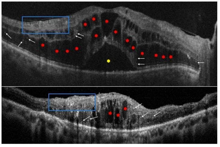 Two diagnostic images consisting of cross-sectional spectral-domain optical coherence tomography (SD-OCT) scans of the retina in patients with diabetic macular edema (DME). The top scan displays significant intraretinal cystic spaces (marked with red asterisks) disrupting the normal foveal contour, alongside a prominent area of subretinal fluid (yellow asterisk). The bottom scan shows further intraretinal cysts and generalized retinal thickening. Both scans highlight key morphological biomarkers: hyperreflective foci (white arrows), which are small, punctate, high-intensity spots scattered across various retinal layers, and Disorganization of the Retinal Inner Layers (DRIL, blue boxes), where the borders between the ganglion cell-inner plexiform layer complex and the inner nuclear layer are no longer identifiable. These features are clinically significant in ophthalmology for assessing disease severity, monitoring response to anti-VEGF or corticosteroid therapy, and predicting visual prognosis in diabetic retinopathy.