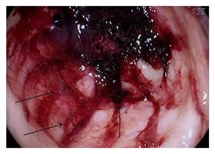 This endoscopic image provides a close-up view of the rectal lumen, demonstrating severe mucosal pathology characteristic of ischemic colitis in a patient with sickle cell disease. The diagnostic image reveals a rectum with diffuse, intense erythema and extensive mucosal hemorrhage, evidenced by widespread bright red blood and friability. Notable features include multiple large, irregular ulcerations that disrupt the normal mucosal architecture. Several of these ulcerated areas are covered with dark, blackish hematin, indicating recent bleeding and tissue necrosis. The surrounding vascular pattern is markedly diminished or absent, replaced by inflammatory exudates and edema. This visual representation serves as an educational tool for identifying colonic ischemia, highlighting the critical endoscopic signs of hemorrhagic and ulcerative tissue damage associated with vaso-occlusive complications in hematologic disorders.