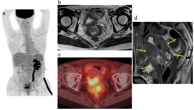 This composite diagnostic image illustrates a case of FIGO stage IVA cervical cancer through multiple modalities. (a) Maximum-intensity-projection (MIP) PET image showing high metabolic activity in the pelvic region and identifying secondary left hydronephrosis due to ureteral obstruction. (b) Axial T2-weighted MRI and (c) corresponding axial PET/CT fusion image provide detailed anatomical localization of the primary tumor, correlating high FDG uptake with the cervical mass. (d) Sagittal T2-weighted MRI demonstrates an intermediate signal intensity tumor originating in the uterine cervix. Yellow arrows highlight the tumor's extensive local invasion into the uterine body, the vagina, and anteriorly into the posterior wall of the bladder. This series serves as an educational example of advanced gynecological malignancy staging, emphasizing the importance of multimodality imaging (MRI for local soft tissue invasion and PET/CT for metabolic staging) in assessing tumor margins and visceral involvement.