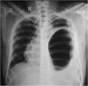 Antero-posterior (AP) chest X-ray demonstrating a large, well-defined area of marked hyper-translucency occupying the majority of the left hemithorax. This lucent region lacks normal bronchovascular markings, and its appearance mimics a massive pneumothorax or a large pulmonary bulla. However, the presence of a distinct curved superior border and the clinical context of traumatic diaphragmatic injury suggest a herniated, air-filled stomach (gastric bubble) within the thoracic cavity. There is significant mass effect evidenced by a prominent mediastinal shift to the right, displacement of the cardiac silhouette, and compression of the contralateral right lung. The left hemidiaphragm is obscured by the gas-distended structure. This imaging finding is characteristic of a large traumatic diaphragmatic hernia causing tension-like effects on mediastinal structures, requiring differentiation from tension pneumothorax to avoid inappropriate chest tube insertion.