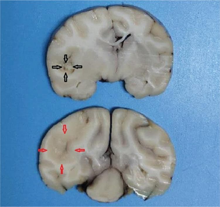 This clinical photograph displays two coronal gross pathology sections of a brain specimen, illustrating the morphological changes associated with a cerebral infarction. The sections demonstrate an area of ischemic damage localized to the territory of the middle cerebral artery (MCA). In the bottom section, red arrows delineate the boundary of the infarct lesion, which appears as a paler, fainter region with lost structural definition compared to the surrounding viable cortical and subcortical tissue. In the top section, black arrows highlight the center of the lesion, where there is clear evidence of liquefactive necrosis. This necrotic core is characterized by a more friable, darker, and fragmented texture, signifying a loss of tissue integrity. These visual markers—pallor at the boundary and central necrosis—are characteristic gross findings of subacute cerebral infarction. The specimen serves as a pathological correlation for neuroimaging findings such as high signal intensity on DWI/T2 sequences, representing the progression from initial ischemia to cellular death and structural breakdown within the brain parenchyma.