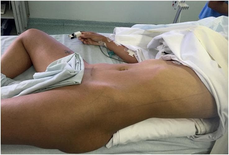 A clinical photograph illustrating the Valdivia position, a specific surgical setup used in urological procedures such as Percutaneous Nephrolithotomy (PCNL). The patient is shown in a modified supine decubitus position on an operating table. To optimize surgical access to the renal area, a large saline bag or firm pillow is placed under the ipsilateral flank, creating a subtle lateral tilt and elevating the kidney. The patient's legs are positioned in a modified lithotomy style: the ipsilateral leg remains extended while the contralateral leg is flexed and abducted. Standard perioperative monitoring is visible, including a pulse oximeter on the index finger and an intravenous line in the forearm. This positioning is designed to allow simultaneous antegrade and retrograde access to the urinary tract while maintaining the hemodynamic advantages of the supine position compared to prone positioning.