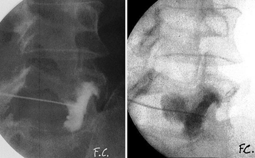 Two side-by-side fluoroscopic images in lateral view demonstrate a zygapophyseal (facet) joint infiltration in the lumbar spine. The images capture a needle or catheter precisely positioned for a percutaneous procedure. Following the injection of a radiopaque contrast medium, both frames reveal significant contrast extravasation extending beyond the expected anatomical borders of the joint capsule. This irregular pooling and flow pattern indicate a rupture of a synovial cyst (SC), confirmed by the loss of contained distribution within the joint space. The left image is presented with higher contrast, emphasizing the radio-dense contrast medium against the vertebral bodies, while the right image shows the same anatomy and pathology with a lighter exposure. The images are intended for educational demonstration of therapeutic synovial cyst rupture under fluoroscopic guidance, highlighting the visual cues for successful cyst decompression.