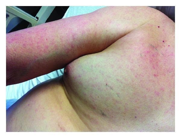 This clinical photograph displays a diffuse, lightly erythematous macular rash on the chest, shoulder, and upper extremity of a patient. The lesions consist of numerous small, blanching or non-blanching red macules that vary in density, appearing most concentrated on the arm and becoming more sparsely distributed across the lateral chest and breast area. The rash is characteristically morbilliform in appearance, suggesting a systemic viral exanthem or drug eruption. Scattered among the macules are a few isolated, more intensely pigmented punctate spots and subtle linear markings on the shoulder region. The overall skin texture remains largely smooth, with no evidence of vesicles, bullae, or desquamation in the visible field. This image is an educational example of common dermatological manifestations of systemic illness, useful for teaching clinical examination and differential diagnosis of acute febrile rashes in dermatology and internal medicine.