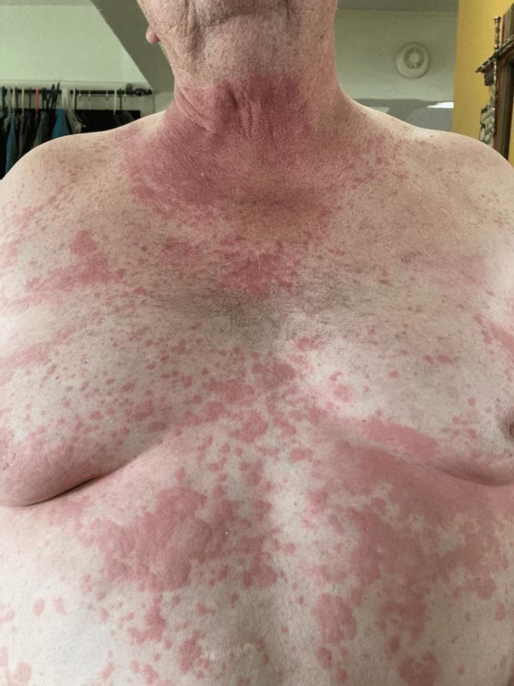This clinical photograph displays a front-facing view of a male patient's neck, chest, and abdomen, showcasing a widespread inflammatory dermatologic reaction. The image demonstrates a mixed eruption characterized by urticaria (hives) and a maculopapular rash. The neck region exhibits intense, confluent erythema, while the chest and abdomen feature a more heterogeneous distribution of lesions. Visible skin findings include numerous erythematous macules, papules, and large, edematous, raised wheals that are beginning to coalesce into irregular, confluent patches. The lesions vary in morphology from small, discrete pink spots to larger, intensely red, elevated plaques with indistinct borders. This clinical presentation is typical of a systemic hypersensitivity reaction, specifically occurring in this context as a manifestation of alpha-gal syndrome (mammalian meat allergy) following beef consumption. The visual evidence emphasizes the extensive distribution and polymorphic nature of the rash, illustrating key diagnostic physical signs of IgE-mediated allergic responses in medical education.