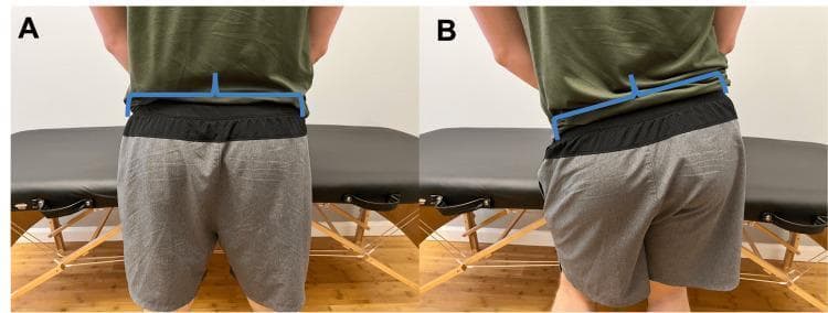 Clinical photograph showing a posterior view of a male subject in two different stances (A and B) to illustrate Trendelenburg gait. Blue graphical overlays are used to indicate pelvic and spinal alignment. Figure A demonstrates normal pelvic stability; the horizontal line across the iliac crests is level and the vertical line through the lumbar spine is perpendicular, indicating effective hip abductor stabilization. Figure B demonstrates a positive Trendelenburg sign, characterized by an inferior pelvic drop on the contralateral (unsupported) side. The horizontal overlay shows a distinct downward tilt toward the left, while the vertical spinal line leans away from the midline, reflecting compensatory truncal shift. This comparison highlights hip abductor weakness, typically involving the gluteus medius and minimus muscles. The image is an educational tool for physical therapy and orthopedic functional assessment, illustrating how pelvic instability alters the kinetic chain and contributes to musculoskeletal issues like knee pain.