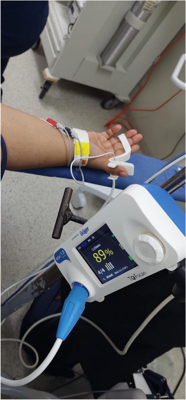 This clinical photograph illustrates the setup for Train-of-Four Ratio (TOFR) monitoring using an acceleromyographic (AMG) device in an anesthetic setting. The image shows the non-dominant hand and forearm of a patient with two peripheral nerve stimulator electrodes positioned over the ulnar nerve at the wrist and distal forearm. A white acceleromyographic sensor is attached to the second or third finger to detect muscular contractions of the adductor pollicis or flexor muscles. Adjacent to the patient, a Dräger TOFScan® monitor displays real-time neuromuscular blockade data, including a TOFR of '89%', a '4/4' twitch response indicated by four vertical bars, and a stimulation current of 40mA. This procedural image demonstrates the clinical application of quantitative neuromuscular monitoring to assess the depth of blockade and ensure safe recovery before extubation. Key educational concepts include the anatomical placement of electrodes for ulnar nerve stimulation and the interpretation of objective TOF values in anesthesiology.